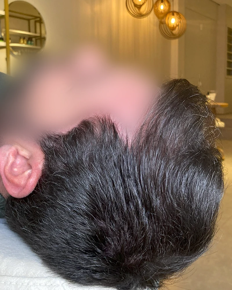 Tratamento Queda de Cabelo - Dra Camila Giongo10